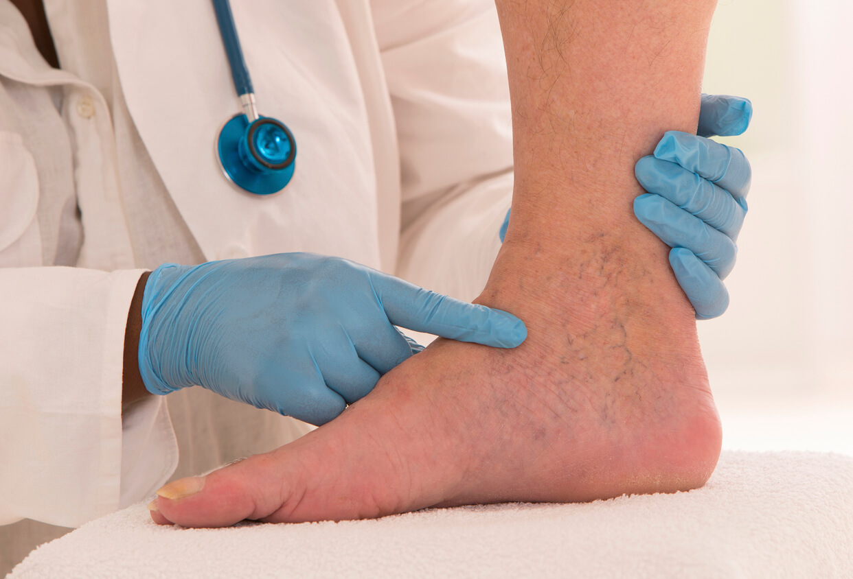 How to Treat Chronic Venous Insufficiency - The Vein Center of Maryland